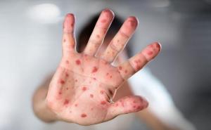Lijepe vijesti: Proglašen prestanak epidemije morbila u Kantonu Sarajevo